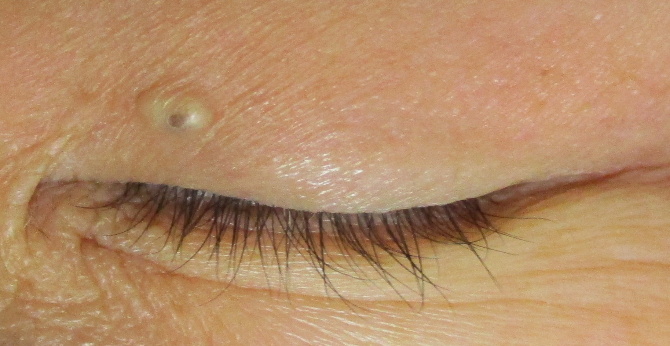 瞼の 粉瘤腫　